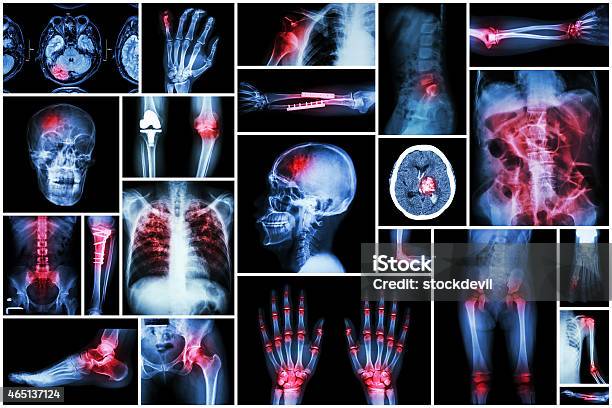 Xray Multiple Disease Stock Photo - Download Image Now - Ankle, Rear View, 2015