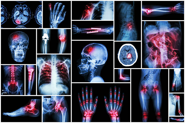 x-ray várias doenças - cat scan pelvis hip human spine - fotografias e filmes do acervo