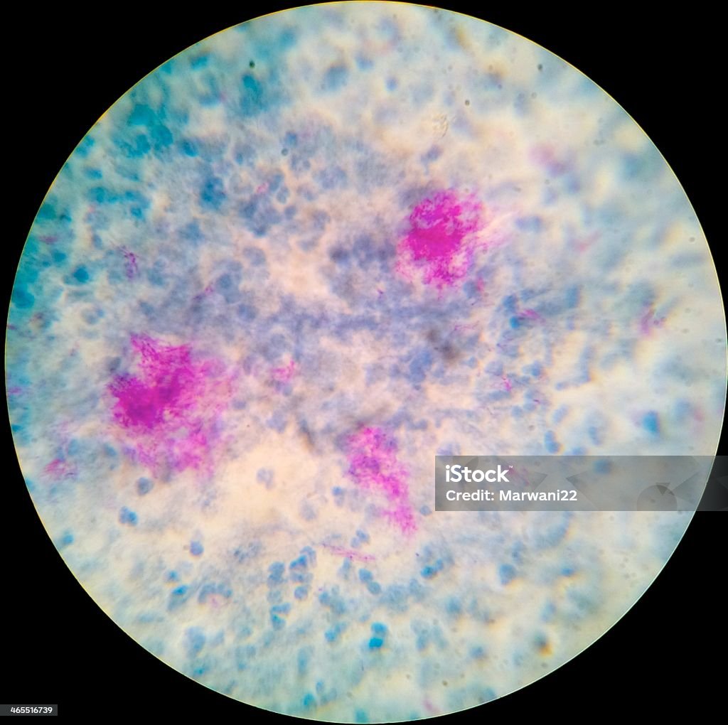 抗酸菌染色 bacilli-ツィール neelsen - ストックフォト・写真素材...