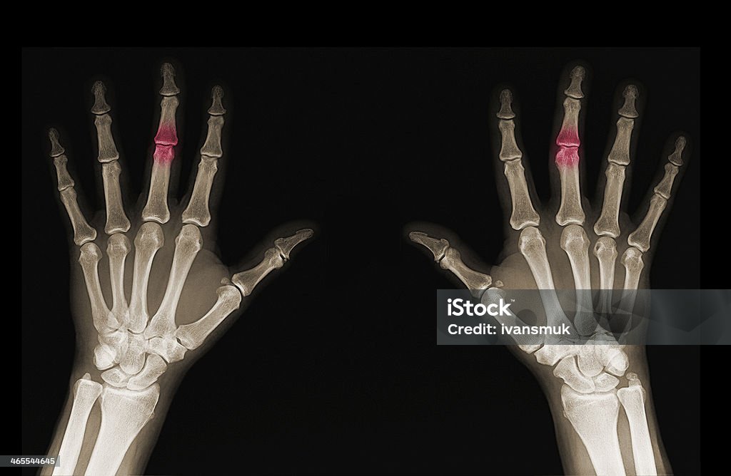 X-ray of hands X-rays of hands of an adult man with visible damage Anatomy Stock Photo