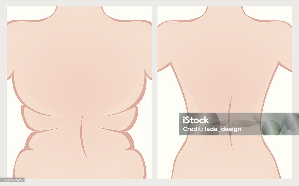 Gordura para antes e depois do tratamento. - Vetor de De Dieta royalty-free