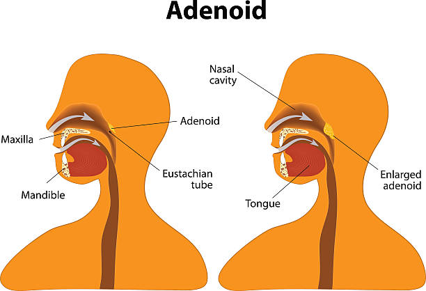 adenoid. нормальная, и увеличенная adenoid - eustachian tube stock illustrations