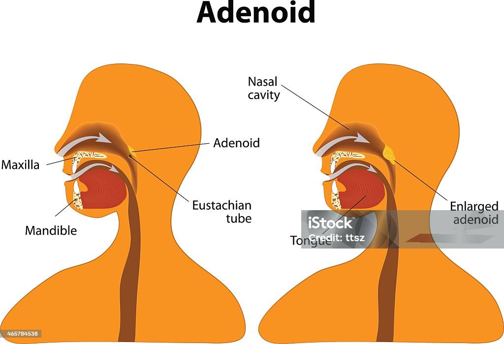 Normal Adenoids Adenoid Normal And Enlarged Adenoid Stock Illustration - Download Image ...