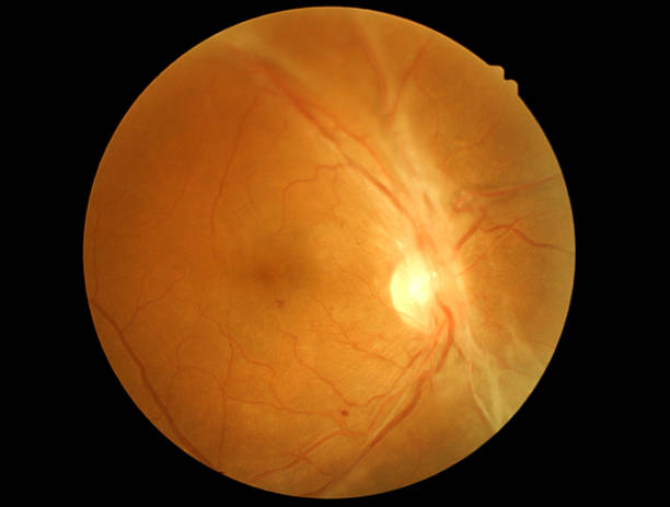 istock retina of diabetic retinophaty 465947373