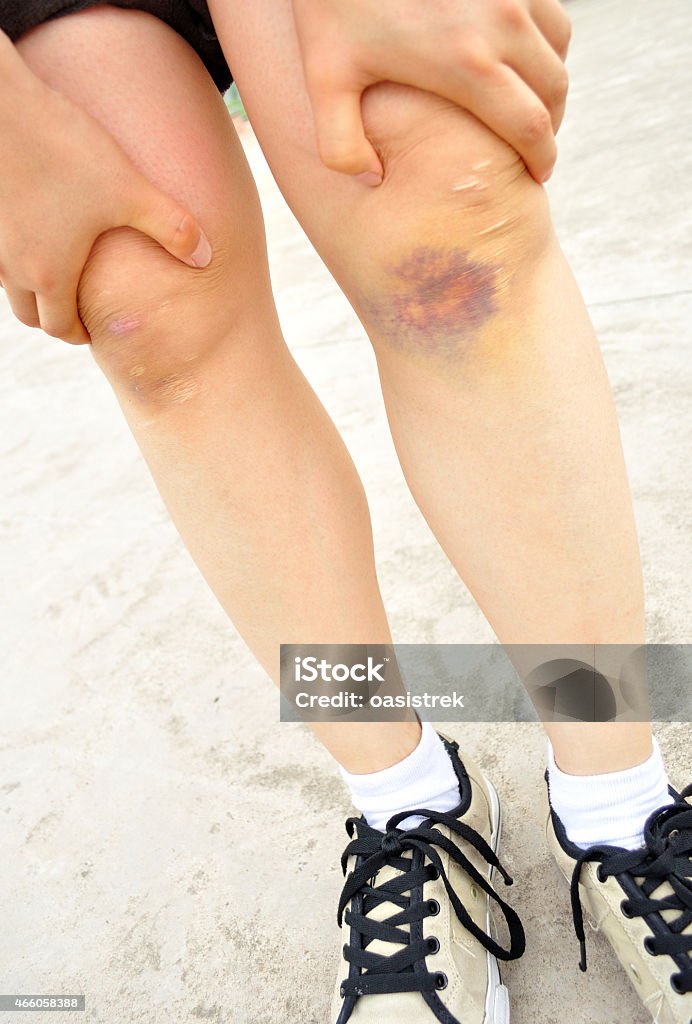 sports injured knee sports injured knee closeup 2015 Stock Photo