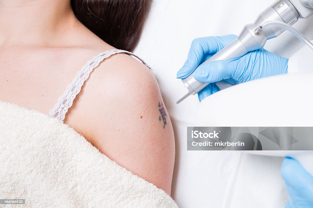 Removing tattoo Removing tattoo on arm of a young woman by medical laser. Tattoo Stock Photo