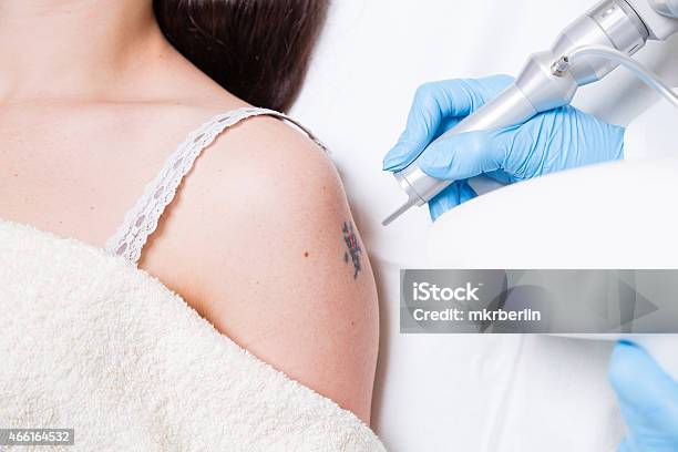 Removing Tattoo Stock Photo - Download Image Now - Tattoo, Removing, Medical Laser