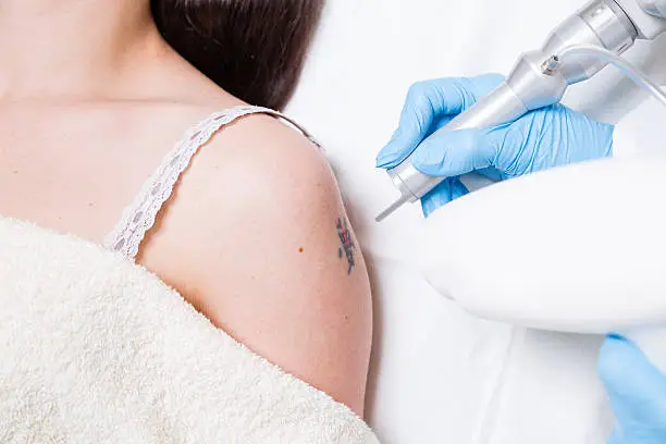 Removing tattoo on arm of a young woman by medical laser.