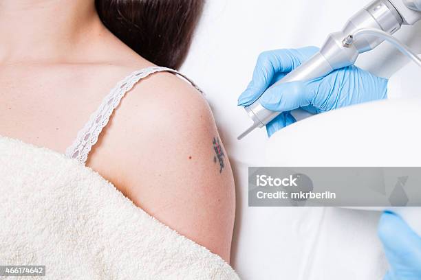 Tattoo Removing Stock Photo - Download Image Now - Removing, Tattoo, Medical Laser