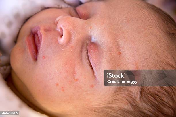 Newborn Baby With Baby Acne Sleeping Stock Photo - Download Image Now - Baby - Human Age, Acne, Newborn