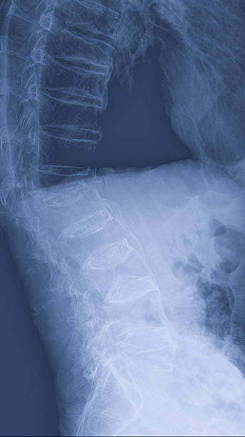istock spine and pelvis x ray 466315260