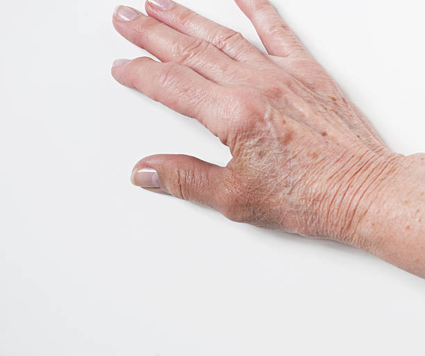 istock Injured Thumb of Elderly Hand 466415512