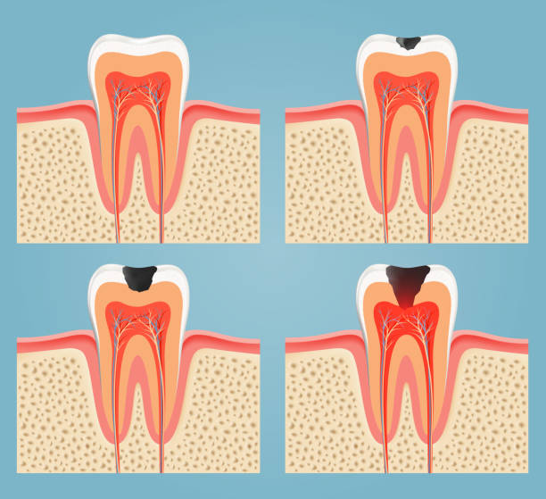 ilustraciones, imágenes clip art, dibujos animados e iconos de stock de etapas de caída de piezas dentales - filling