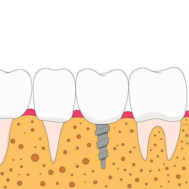 Implante dentário - ilustração de arte vetorial