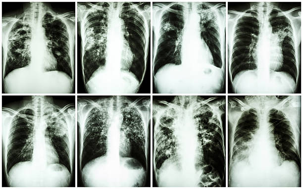 istock Eight chest X-rays exhibiting pulmonary tuberculosis 466596694