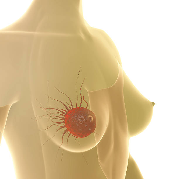 Breast Cancer - 3d rendered illustration stock photo