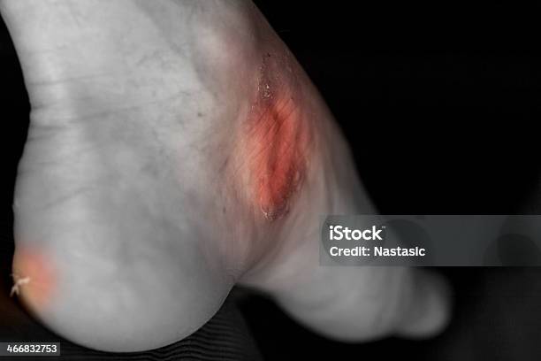 Foot Fungus Stock Photo - Download Image Now - Aiming, Alternative Therapy, Ankle