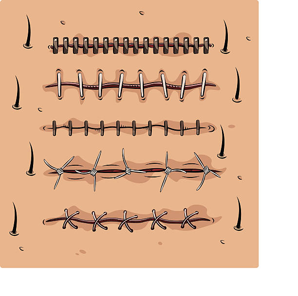 Surgical stitches A set of surgical stitches or sutures on the skin. scar stock illustrations