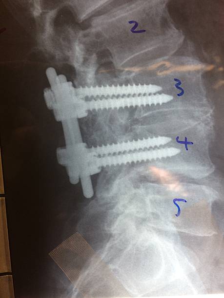 요추 결합, pedical 나사 - orthopedic equipment osteoporosis x ray human spine 뉴스 사진 이미지