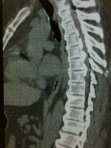 Sagittal Reformatted CT scan of the human thoracic spine with OPLL change. OPLL is normal on cervical area, and it is extremely rare on thoracic area. Most patients are Asian.