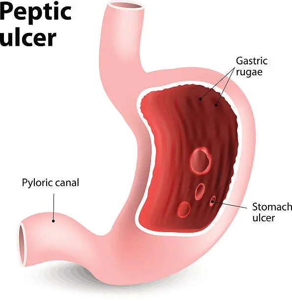 Vector illustration of peptic ulcer