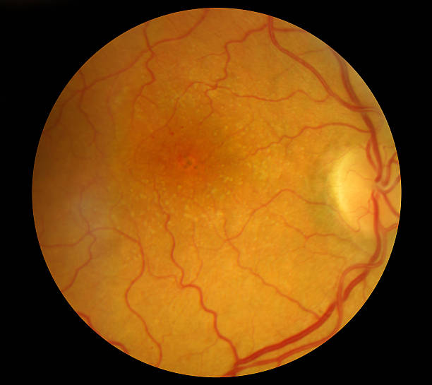 Medical Fundus photo of retinal pathology, hemmorhages, vein occ Medical Fundus photo of retinal pathology, hemmorhages, vein occlusion, macular degeneration atrophy stock pictures, royalty-free photos & images