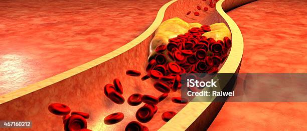 Illustration Of A Clogged Artery With Platelets And Plaque Stock Photo - Download Image Now