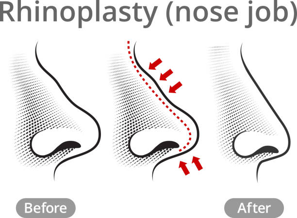 ilustrações, clipart, desenhos animados e ícones de nariz humano trabalho antes de & depois - nose job illustrations