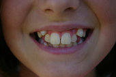 Young Girls Teeth Close-up