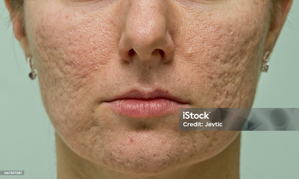 Problematic skin Frontal view of girl's cheeks and chin with acne scars Acne Stock Photo