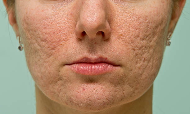 Problematic skin Frontal view of girl's cheeks and chin with acne scars bumpy stock pictures, royalty-free photos & images
