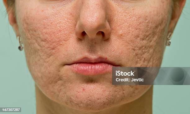 Problematic Skin Stock Photo - Download Image Now - Acne, Scar, Human Face