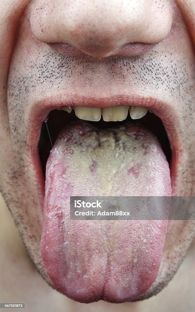 Enfermedad de lengua - Foto de stock de Blanco - Color libre de derechos