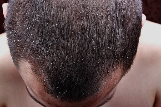 Psoriasis skin Symptoms of the disease psoriasis in hair dandruff men stock pictures, royalty-free photos & images