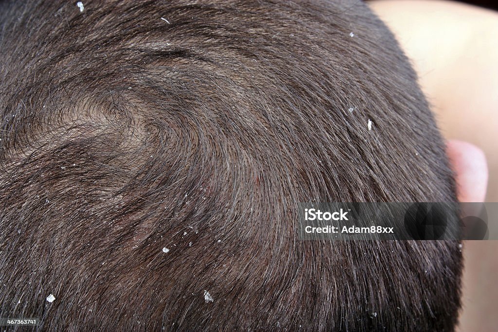 Dandruff in the hair The symptoms of psoriasis scalp in the hair Dandruff Stock Photo