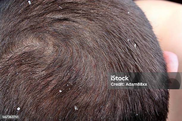 Dandruff In The Hair Stock Photo - Download Image Now - Dandruff, Adipose Cell, Adult