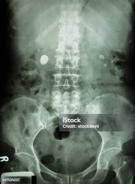 Pedra Renal Bilateral - Fotografias de stock e mais imagens de Imagem de raios X - Imagem de raios X, Abdómen Animal, Bexiga