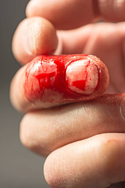 Cut off fingernail on index finger of hand