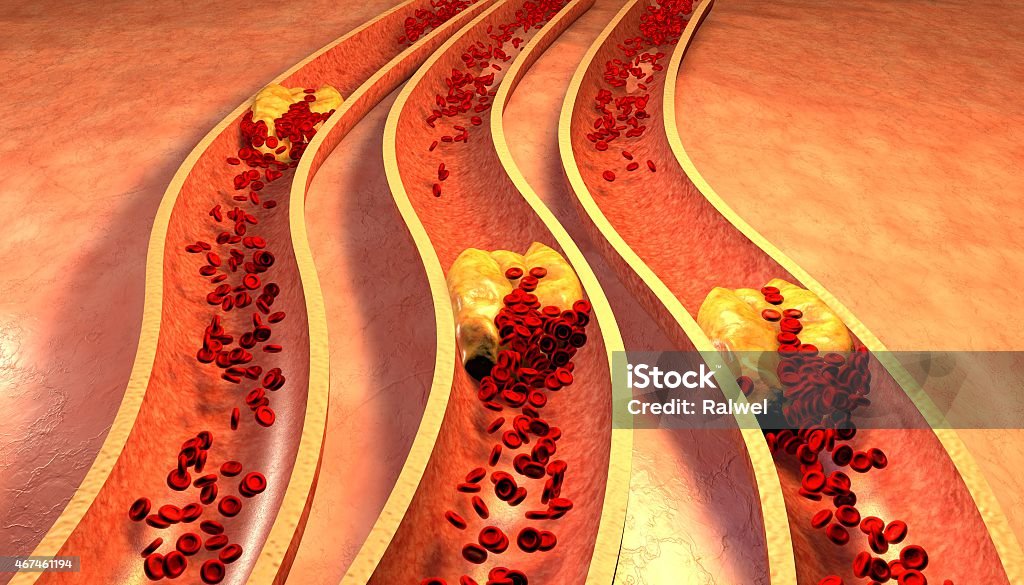 Image of vein clogged with cholesterol plaque and platelets Clogged Artery with platelets and cholesterol plaque, concept for health risk for obesity or dieting and nutrition problems Occlusion Stock Photo