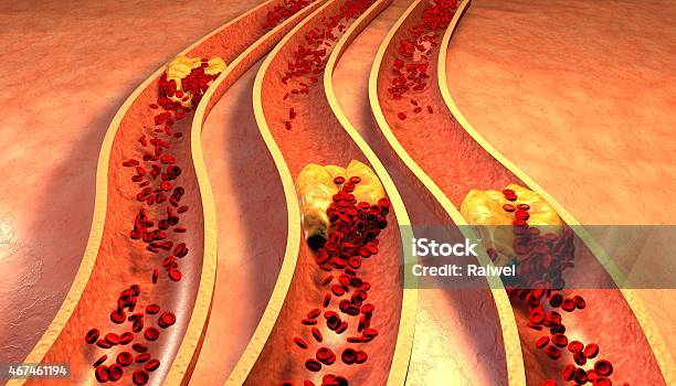 Image Of Vein Clogged With Cholesterol Plaque And Platelets Stock Photo - Download Image Now