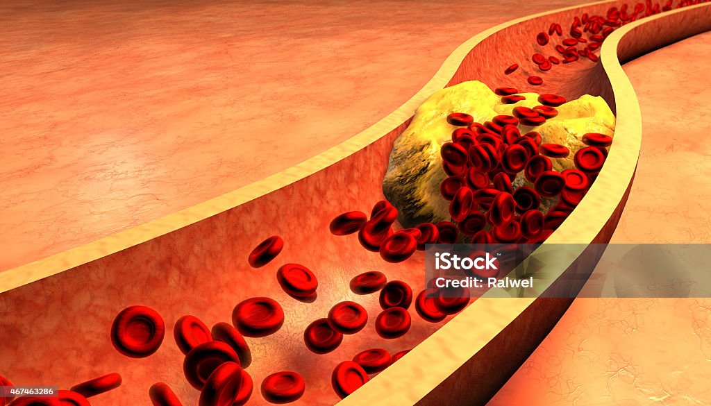 Clogged Artery with platelets and cholesterol plaque Clogged Artery with platelets and cholesterol plaque, concept for health risk for obesity or dieting and nutrition problems Cholesterol Stock Photo