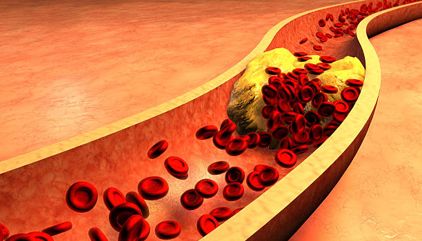 Clogged Artery with platelets and cholesterol plaque Clogged Artery with platelets and cholesterol plaque, concept for health risk for obesity or dieting and nutrition problems cholesterol screening stock pictures, royalty-free photos & images