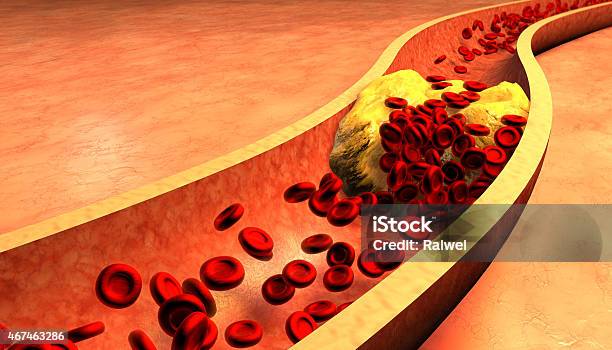 Clogged Artery With Platelets And Cholesterol Plaque Stock Photo - Download Image Now