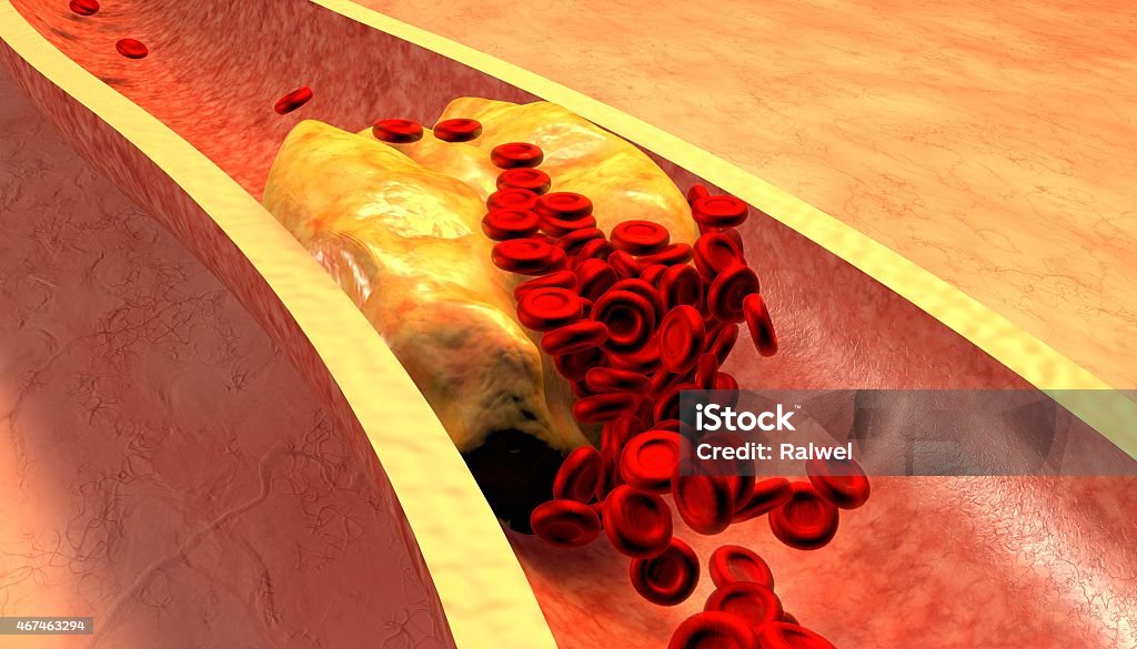 Artère obstrués avec platelets et plaque de cholestérol - Photo de Cholestérol libre de droits