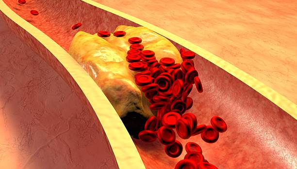 Magnified illustration of a clogged artery with plaque Clogged Artery with platelets and cholesterol plaque, concept for health risk for obesity or dieting and nutrition problems vascular bundle stock pictures, royalty-free photos & images