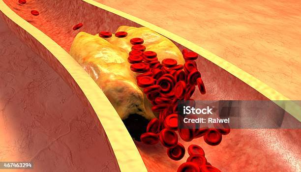 Magnified Illustration Of A Clogged Artery With Plaque Stock Photo - Download Image Now