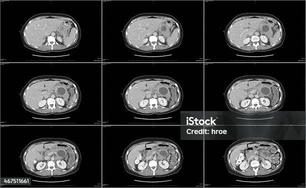 Foto de Tomografia Computadorizada Pâncreas e mais fotos de stock de Exame de ressonância magnética - Exame de ressonância magnética, Cisto, Tomografia Computadorizada