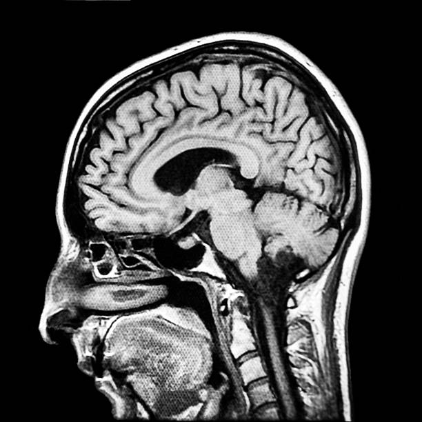 pionowe części ludzkiego mózgu skanowania mri - radiogram photographic image zdjęcia i obrazy z banku zdjęć