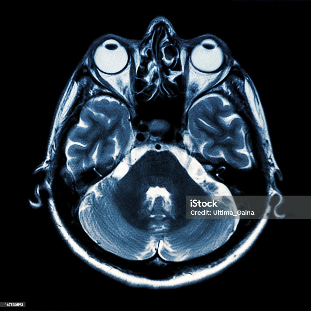 Horizontale partie du cerveau humain Image à résonance magnétique - Photo de Accident bénin libre de droits