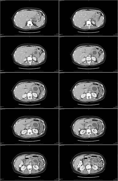 CAT scan pancreas cyst stock photo